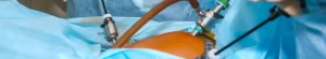 Laparoscopic Gallbladder Surgery: Procedure, Cost & Recovery